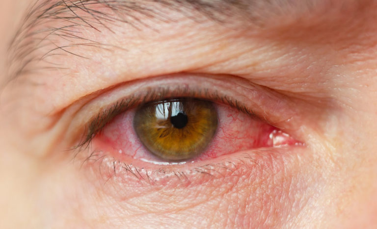 why does weed make your eyes red