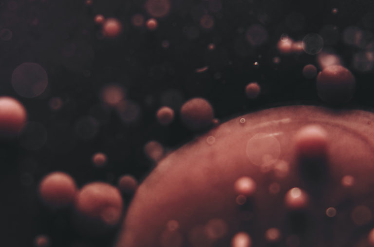 sickle cell disease
